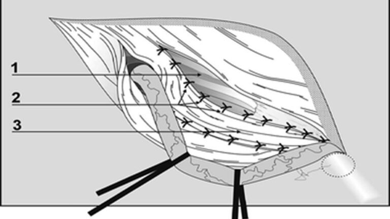 Desarda Hernia Repair