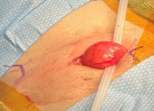 Right inguinal hernia demonstrated under light anesthesia